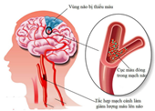 3 dấu hiệu sớm cảnh báo đột quỵ trước cả FAST